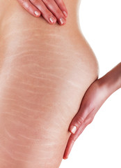 Stretch marks and cellulite - 61130628