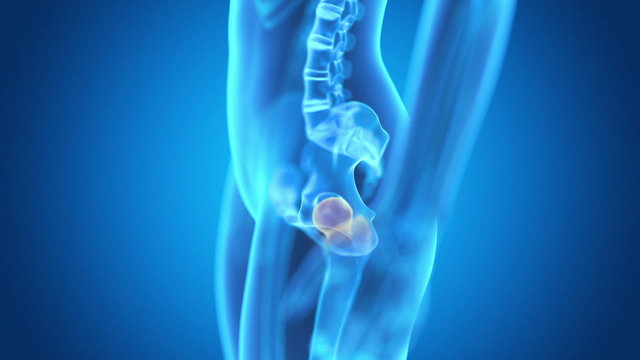medical animation - pain in the hip joint