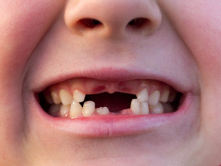 Mouth of boy with Changing Teeth