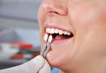 shade determination tooth