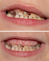 Dental medicine and healthcare - human patient open mouth showin