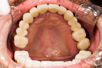 Dental Crowns and Bridges