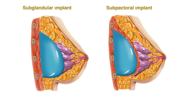 breast implant