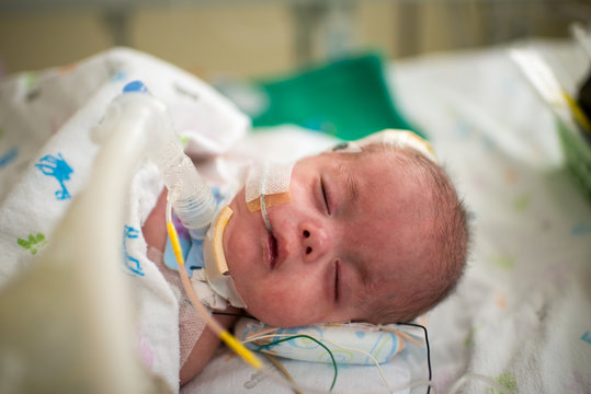 Infant with breathing tube.