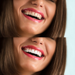 Whitening - bleaching treatment, before and after