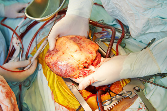 Cardiac surgery heart transplantation