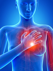 medical 3d illustration - heart attack