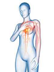 medical 3d illustration - heart attack