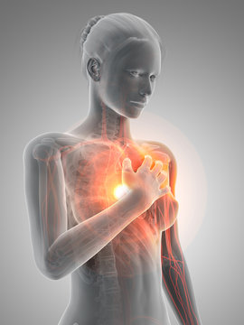 medical 3d illustration - heart attack