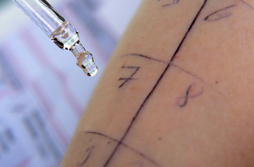 Pipette tropft Immunglobulin Allergietest Pricktest