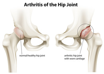Arthritis of the hip joint