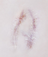 Scar letter A on human skin