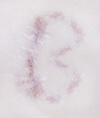 Scar letter B on human skin