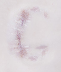 Scar letter G on human skin