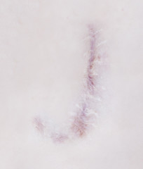 Scar letter J on human skin