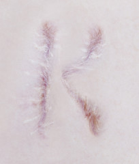 Scar letter K on human skin