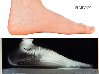flatfoot - 61618461