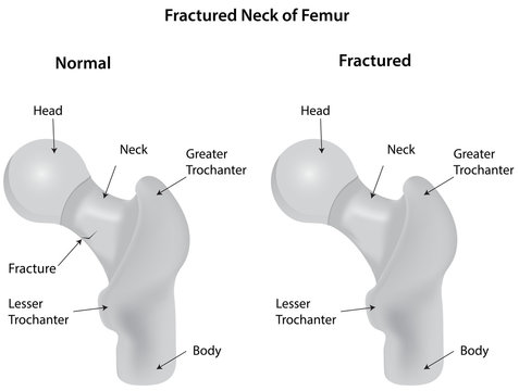 Fractured Neck of Femur