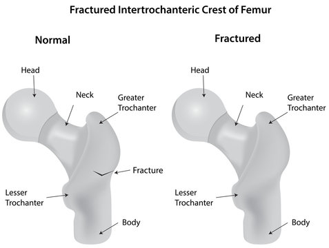 Fractured Intertrochanteric Crest of Femur