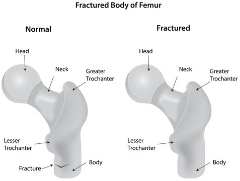 Fractured Body of Femur