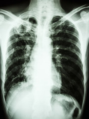 Mycobacterium tuberculosis infection (Pulmonary Tuberculosis)