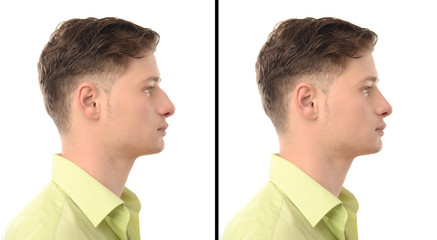Man with nose job plastic surgery.Rhinoplasty before after photo - 61916042