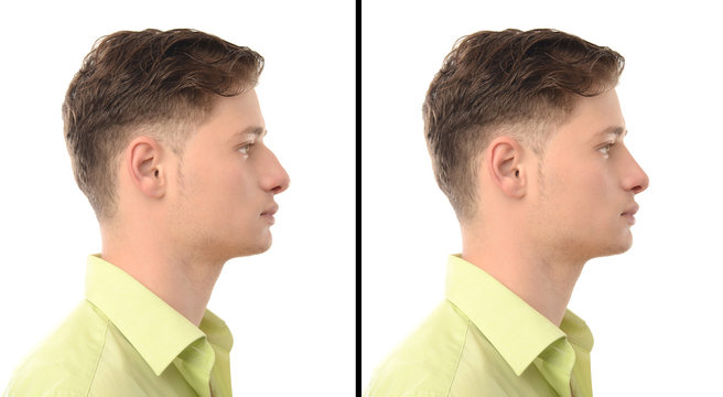 Man with nose job plastic surgery.Rhinoplasty before after photo