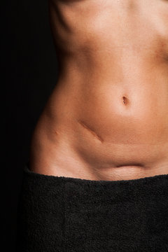 Bauch einer h&uuml;bschen Frau mit Narben
