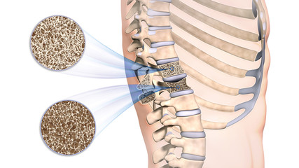 Osteoporose im Rückenwirbel - obrazy, fototapety, plakaty