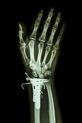 fracture distal radius (forearm's bone). It was operated and ins