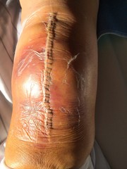 Knie nach einer Operation - Kniegelenksprothese