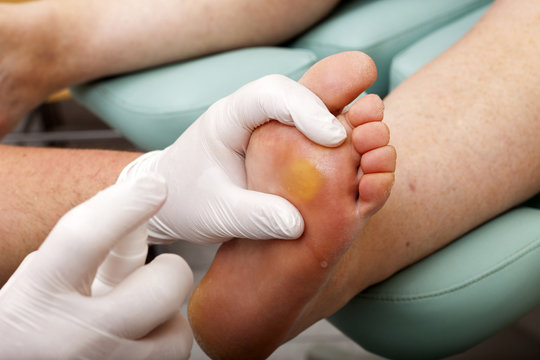 Fußpfleger besprüht Fußsohle mit Desinfektionsmittel