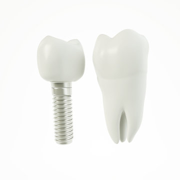 Zahn Implantat