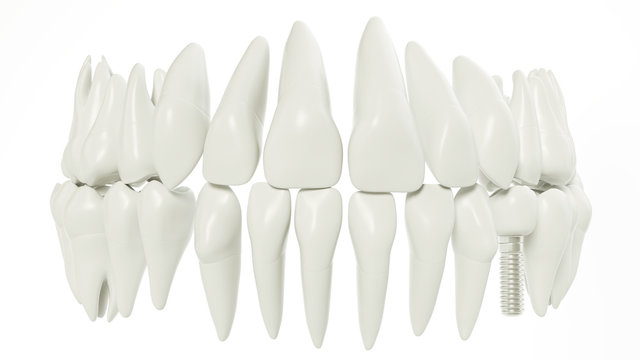 Zahnreihe mit Implantat