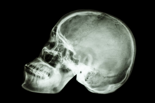 normal human's skull (asian)