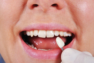 shade determination tooth