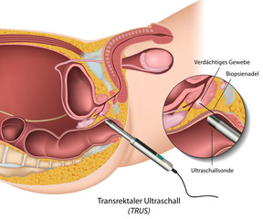 Transrektaler Ultraschall (TRUS)