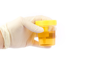 Hand holding an urine sample