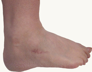 Foot Scar (Bone Fragment Removal)