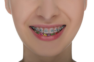 Closeup of smiling mouth with braces on teeth