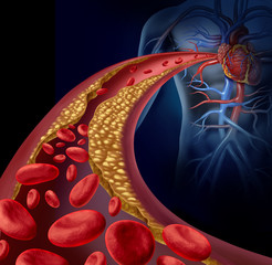 Clogged Artery - obrazy, fototapety, plakaty