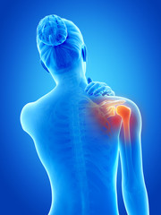 a woman having acute pain in the shoulder joint