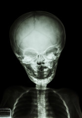 skull and body of child