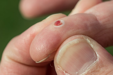 Pyogenic granuloma wound on a finger