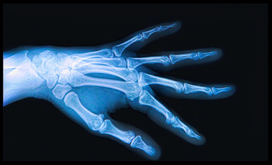 X-ray of  Hand and fingers