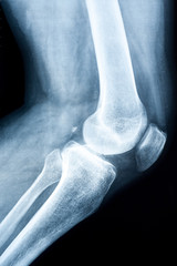 Xray of a human knee