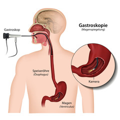 Gastroskopie, Magenspiegelung