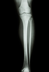 film x-ray normal human's leg