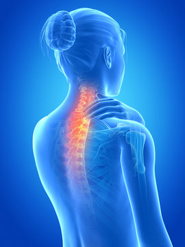 Woman Having A Painful Neck - Visible Spine