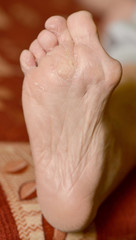 Fototapeta premium problem foot callus